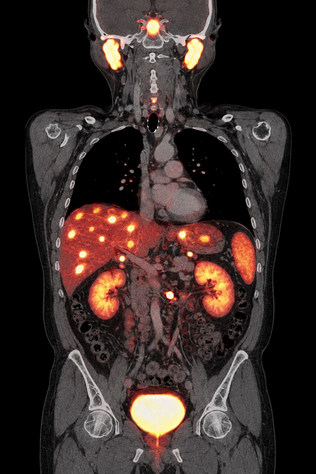 Illustrative coronal gallium-68 DOTATATE PET/CT showing multiple somatostatin-receptor-avid liver metastases and a small avid midgut or mesenteric primary focus, with expected physiologic uptake in the pituitary and salivary region, spleen, adrenal glands, kidneys, and urinary bladder.