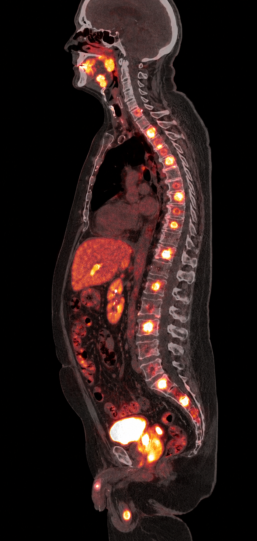 Simulated sagittal fused PSMA PET/CT with PSMA-avid pelvic disease and multiple osseous metastases in the spine and pelvis.