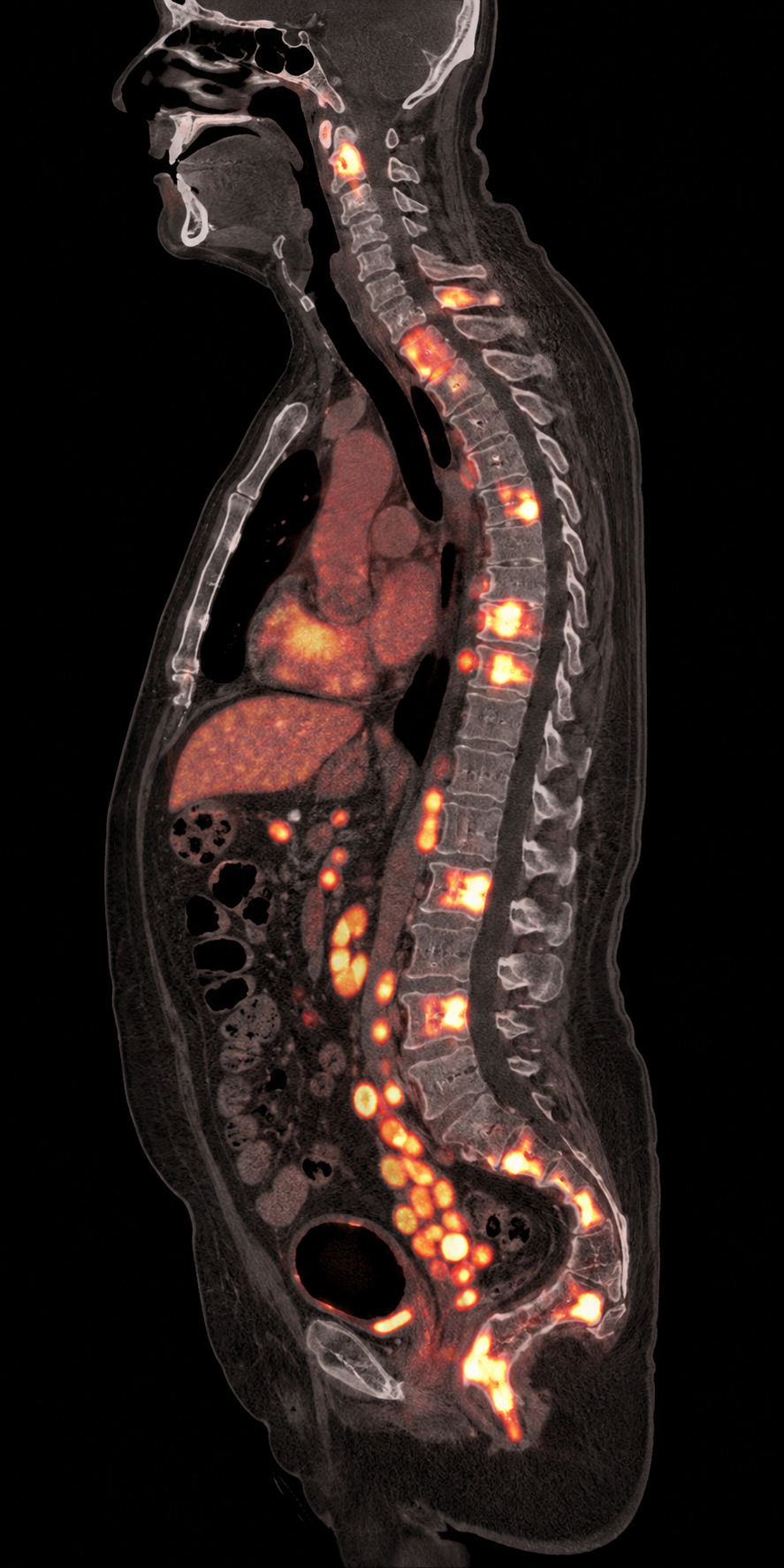 Simulated sagittal fused PSMA PET/CT with multiple PSMA-avid vertebral, pelvic, and nodal metastases.