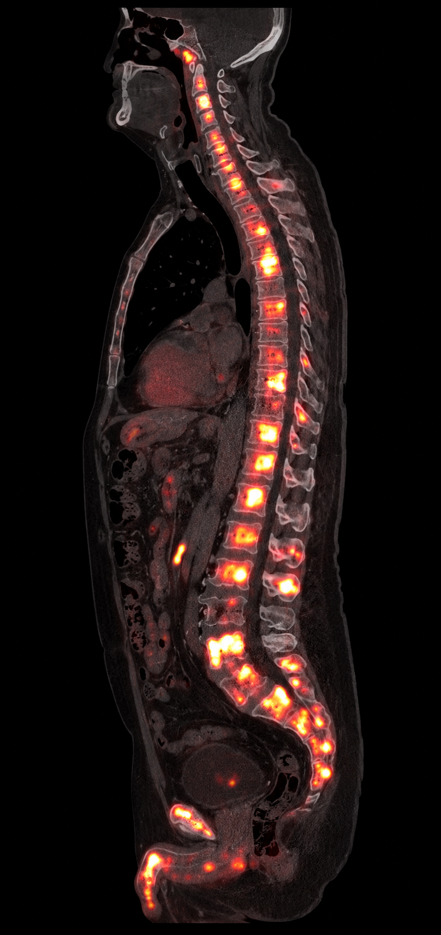 Simulated sagittal fused PSMA PET/CT with high-volume heterogeneous PSMA-avid skeletal metastatic disease.