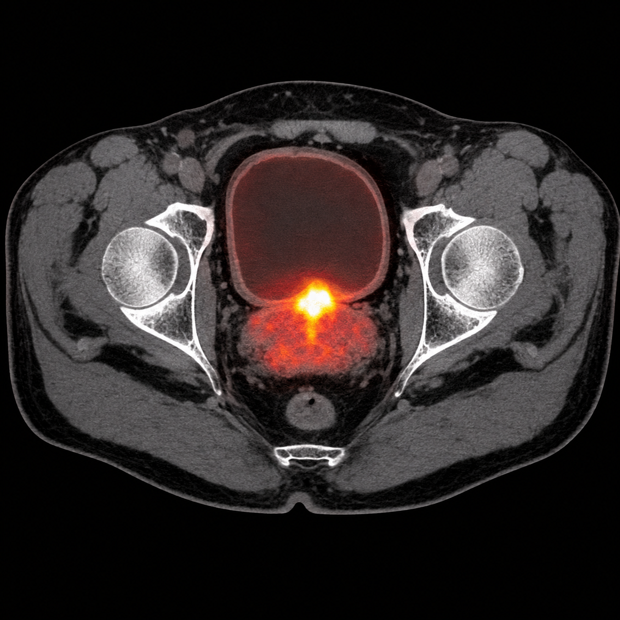 Illustrative axial fused PSMA PET/CT of the pelvis with intense tracer uptake at the prostate and posterior bladder wall interface.