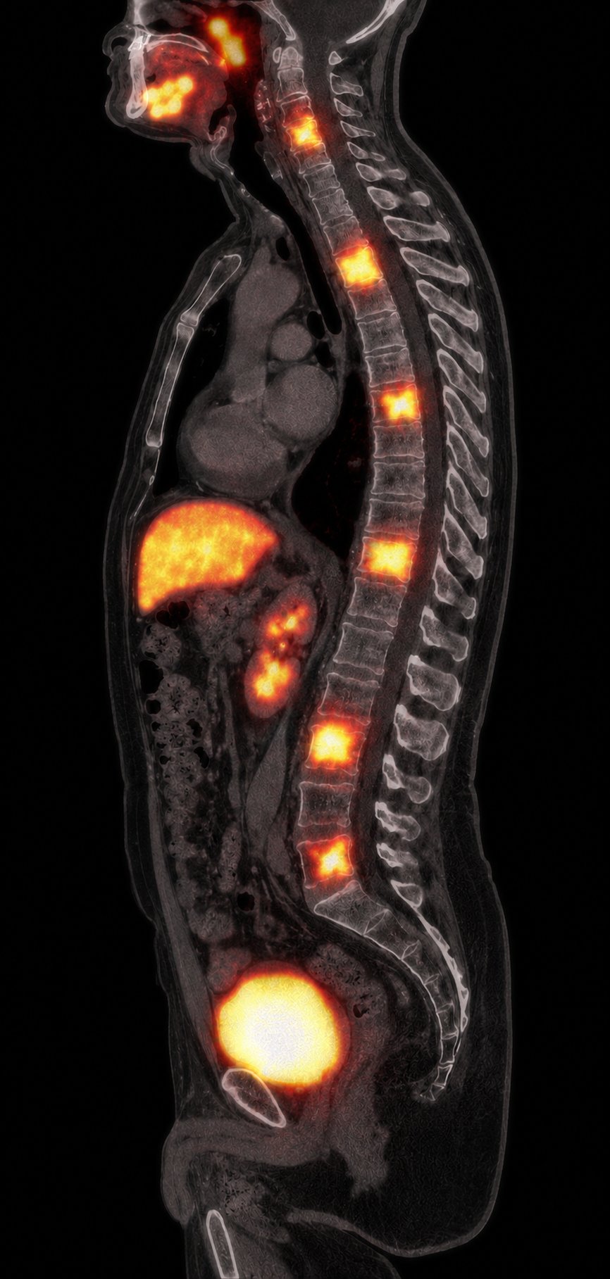 Illustrative post-treatment sagittal lutetium-177 PSMA SPECT/CT showing radioligand activity at the same cervical, thoracic, and lumbar vertebral body targets.