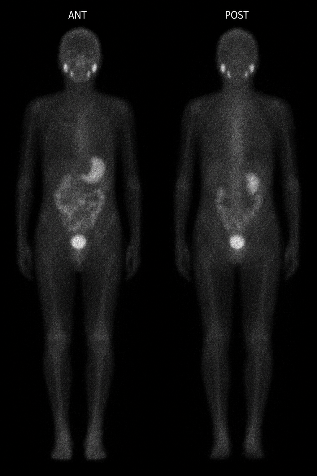 Simulated anterior and posterior follow-up iodine whole-body planar scans one year after ablation with no focal uptake in the neck