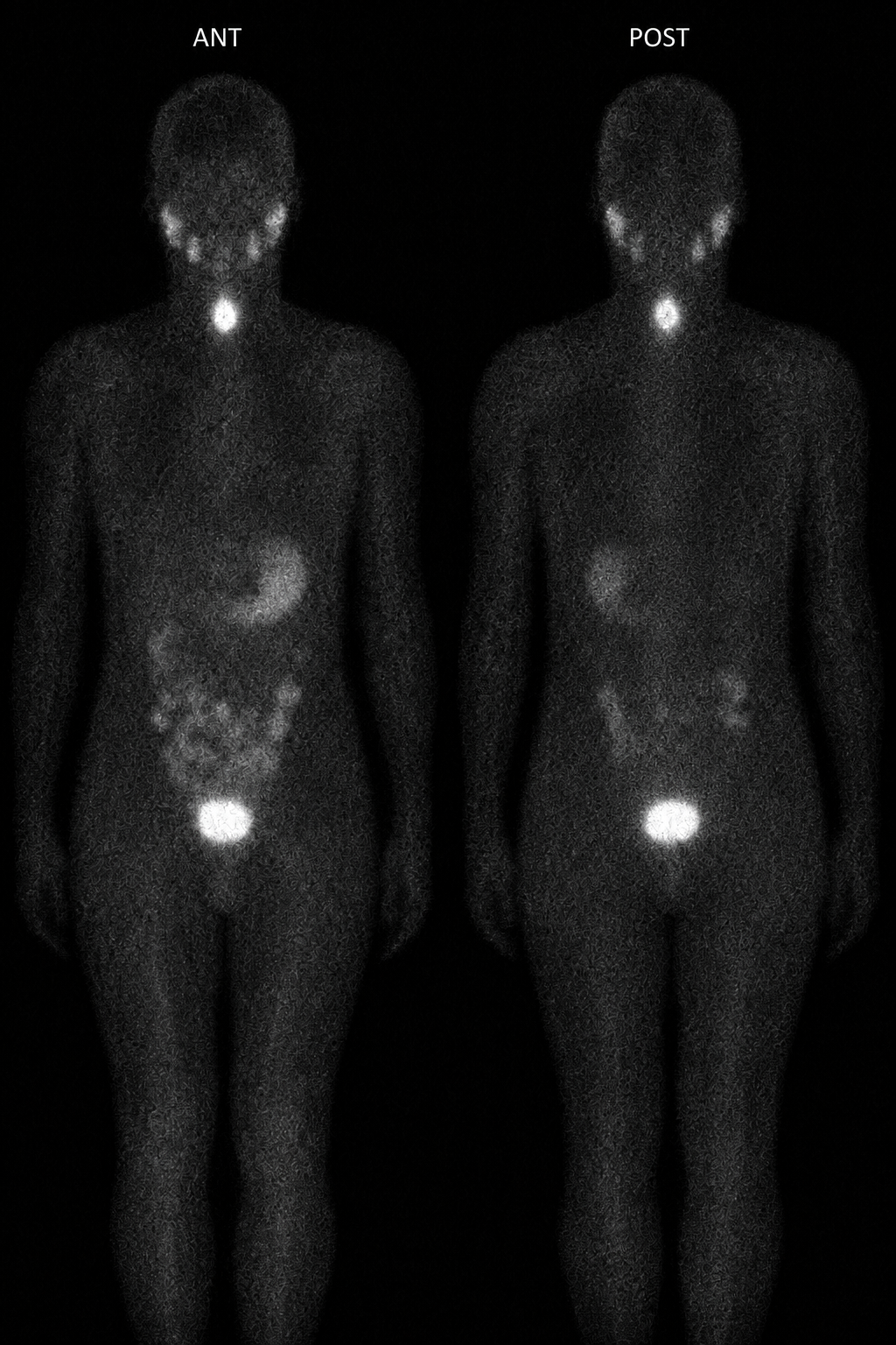 Simulated anterior and posterior post-therapy iodine-131 whole-body planar scans with focal uptake in the anterior midline lower neck thyroid bed