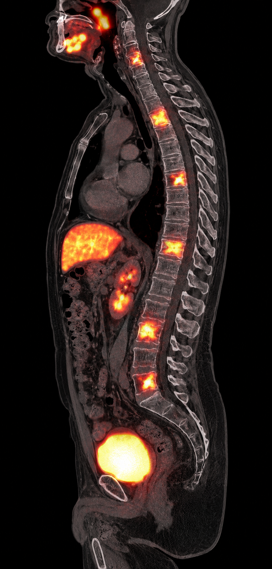 Illustrative sagittal fused gallium-68 PSMA PET/CT with several distinct PSMA-avid lesions in cervical, thoracic, and lumbar vertebral bodies, plus expected physiologic activity in the salivary region, liver, kidneys, and urinary bladder.